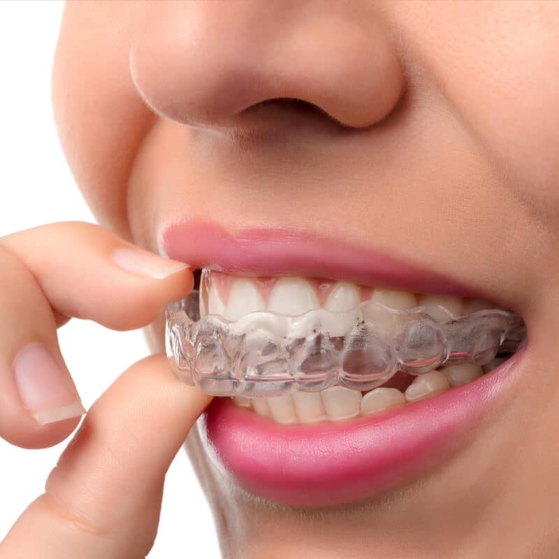 How Invisalign Aligners Interact With Existing Dental Restorations During Orthodontic Treatment